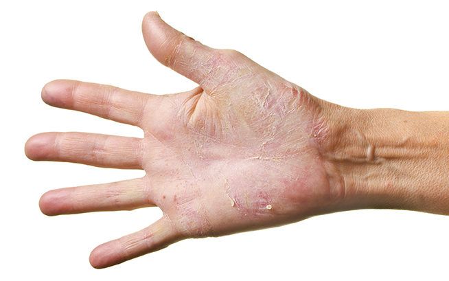 Udtørrede hænder pga håndsprit - før brug af innos hånddesinfektion